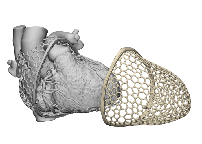 Cardiac surgery Coronary artery three-dimensional reconstruction