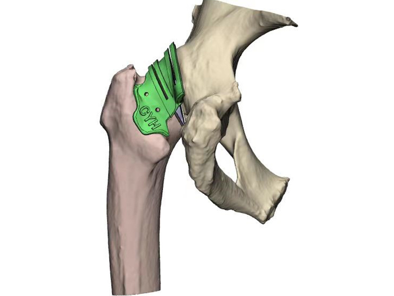 Arthrodesis osteotomy guide plate