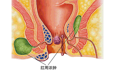 微創(chuàng)加紅光治療肛周疾病療效觀察