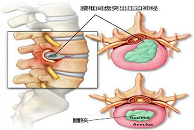 超短波治療儀在腰椎間盤術(shù)后康復(fù)中的臨床應(yīng)用分析