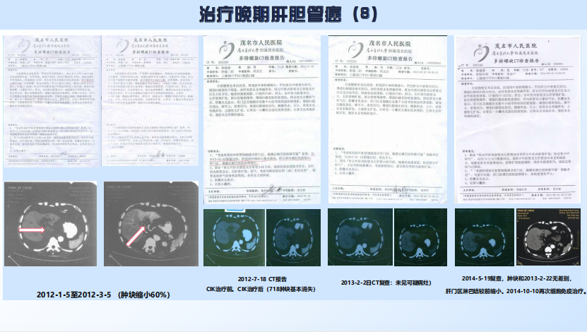 治愈复发脑瘤
