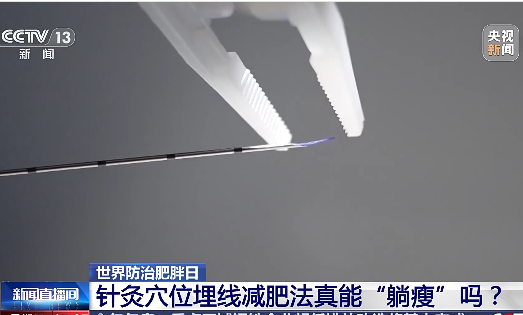 世界防治肥胖日 针灸穴位埋线减肥法真能“躺瘦”吗？
