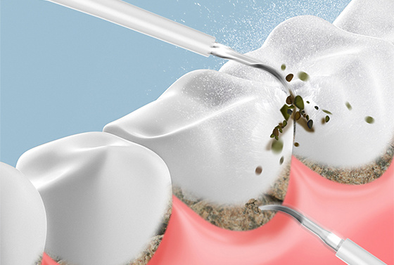 Enhance Your Oral Hygiene Routine with Fancy Oral Irrigators