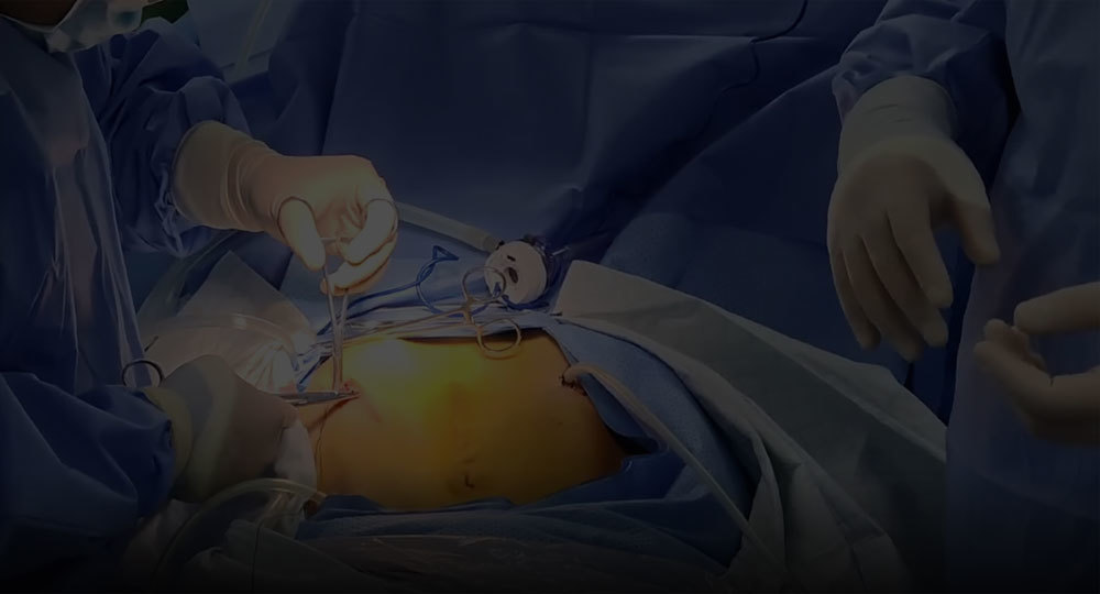 腹腔镜下热灌注治疗 (2)