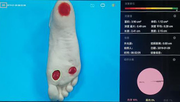 三维伤口测量仪