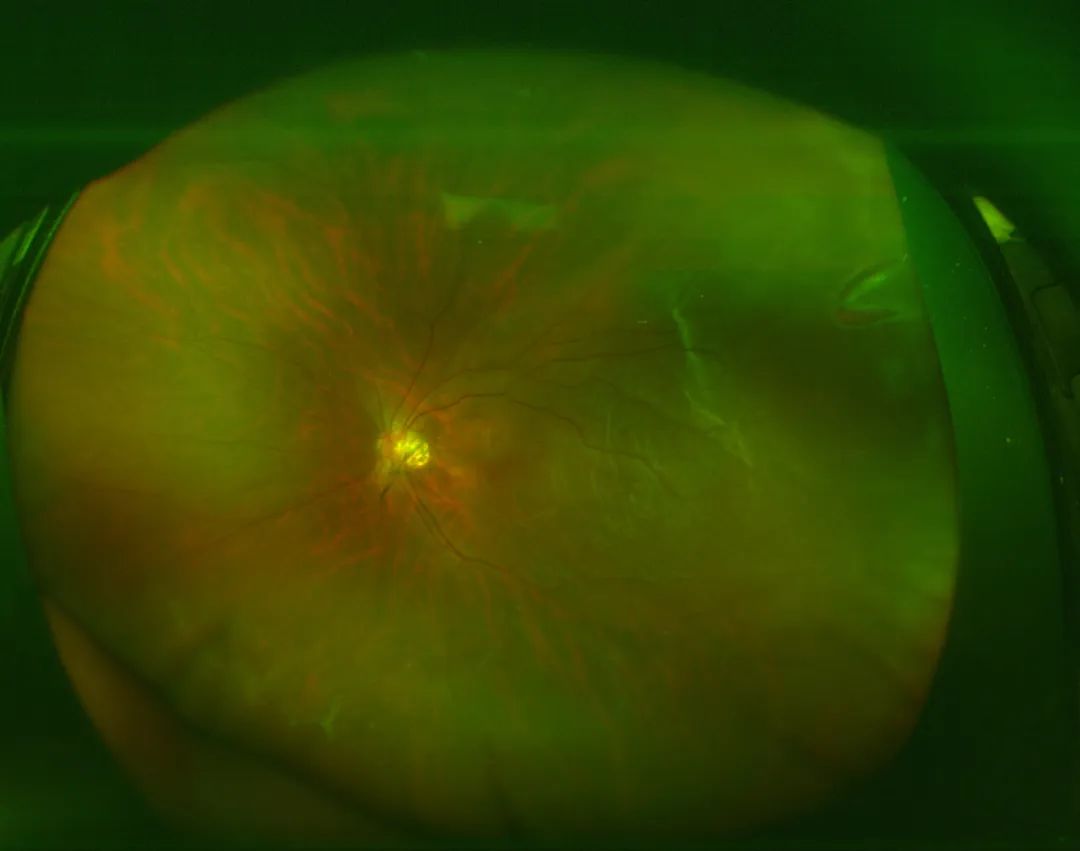 The Eye & ENT Hospital of Fudan University has successfully performed FCB (Foldable Capsular Buckle) scleral buckling retinal reattachment surgery, offering a novel treatment approach for patients with retinal detachment.