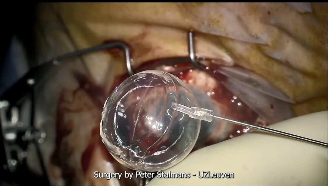 First Successful Third-Generation FCVB Surgery Performed at University Hospitals Leuven, Belgium