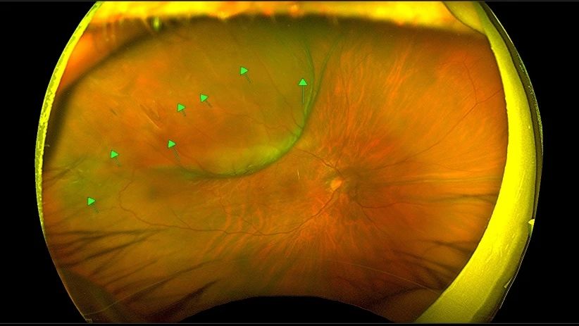 The Ninth Medical Center of the Chinese People's Liberation Army General Hospital Successfully Performed FCB Surgery, Offering a New Treatment Option for Patients with Extensive and Multiple Retinal Holes and Retinal Detachment
