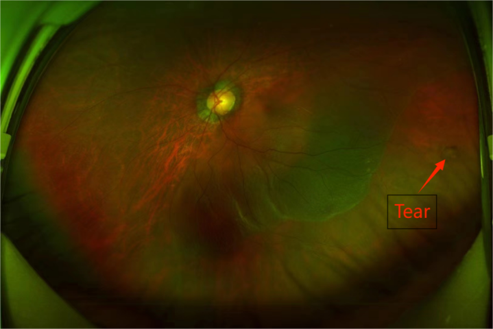 Wuhan Aier Eye Hospital Successfully Performs FCB Surgery, Providing a New Treatment Approach for Retinal Detachment Patients