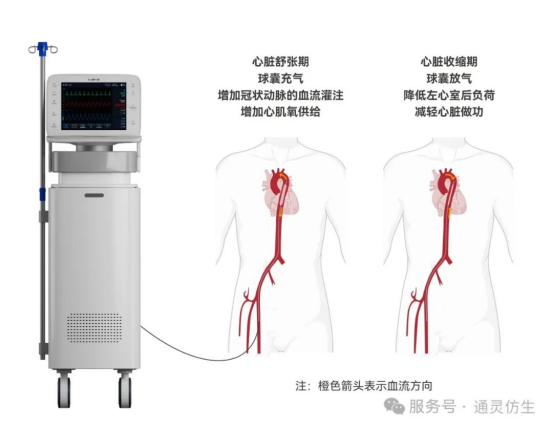 重磅！中国首款自研IABP获批上市