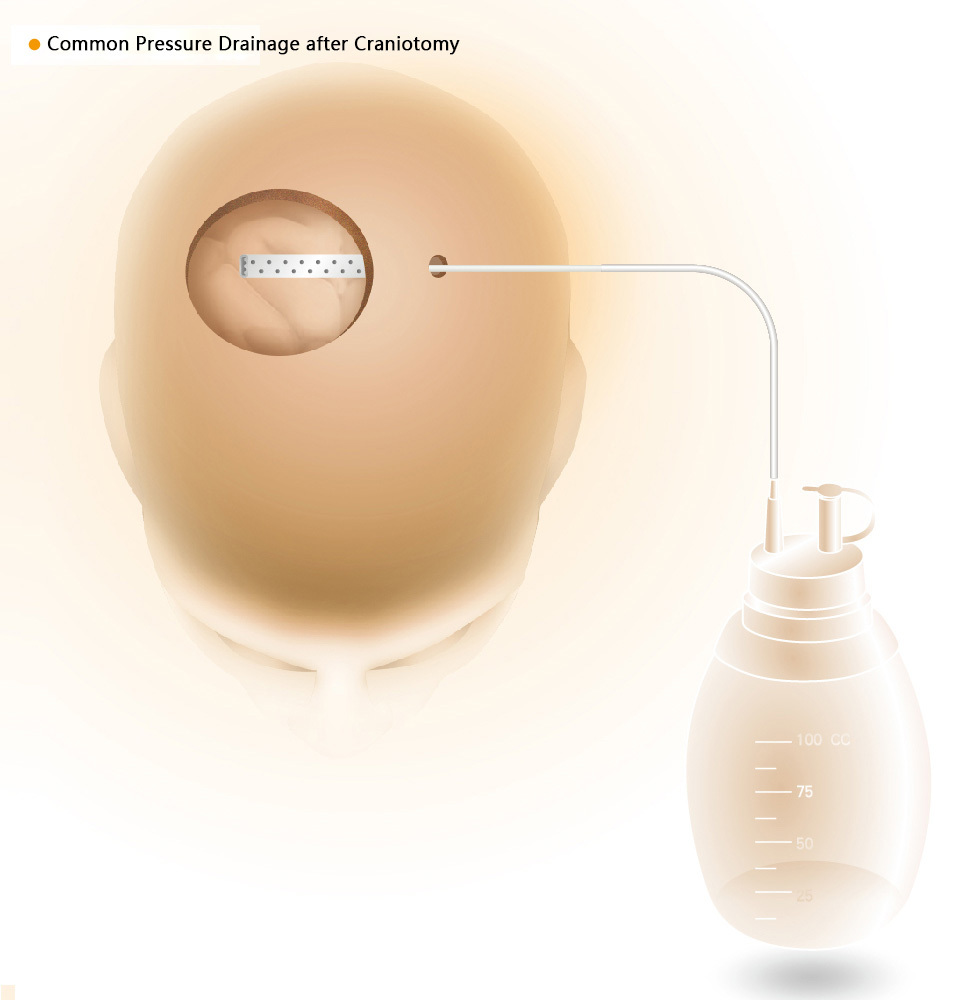 Epidural drainage system