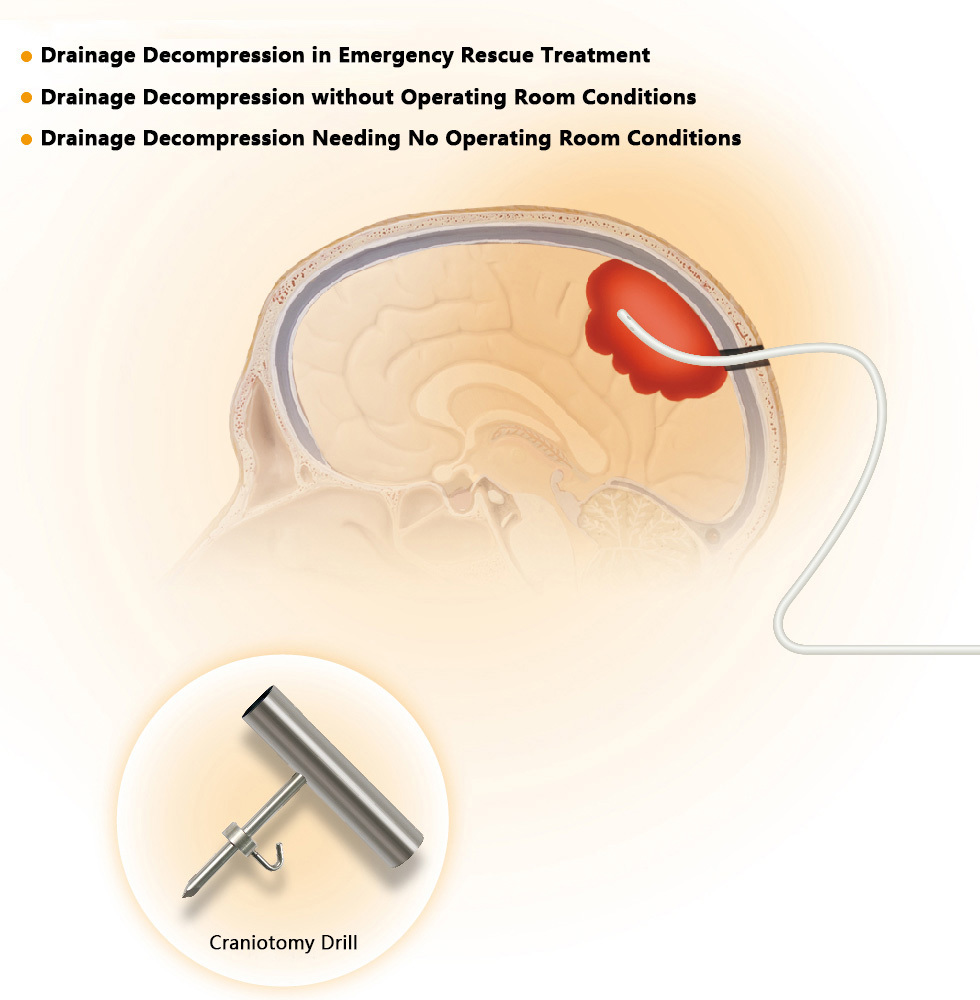 Minimally invasive intracranial drainage system