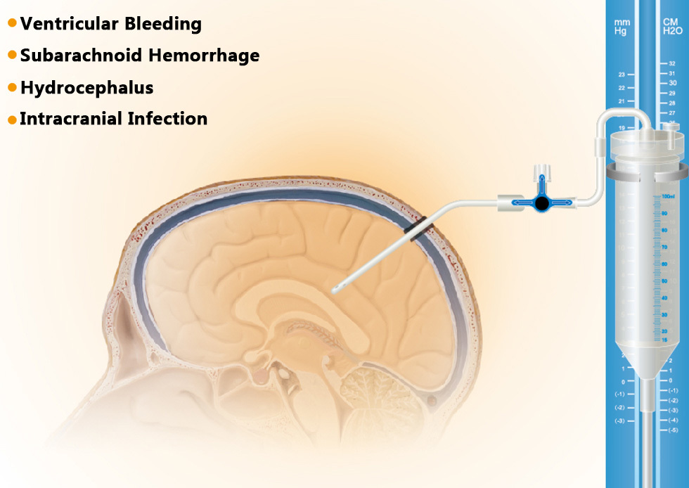 External ventricular drainage system