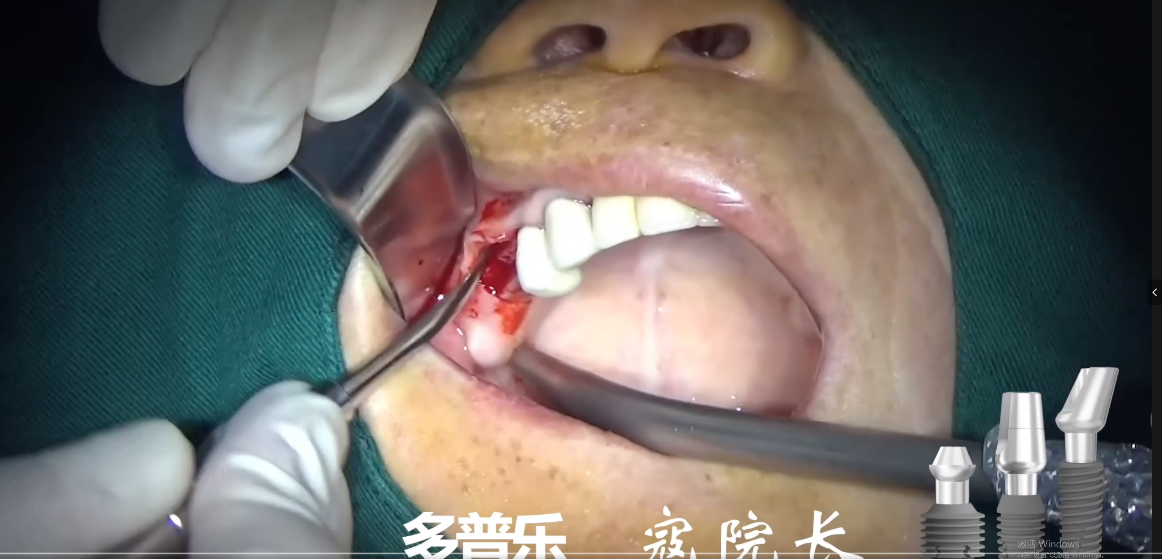 小身材.大作为 多普乐DS系列极限躲避下颌神经管术式