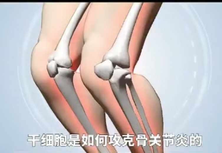 膝关节——骨关节炎