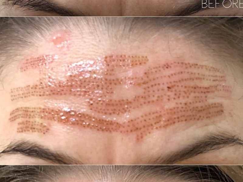 Plasma Skin Tightening: Your Guide To Non-Surgical Skin Rejuvenation