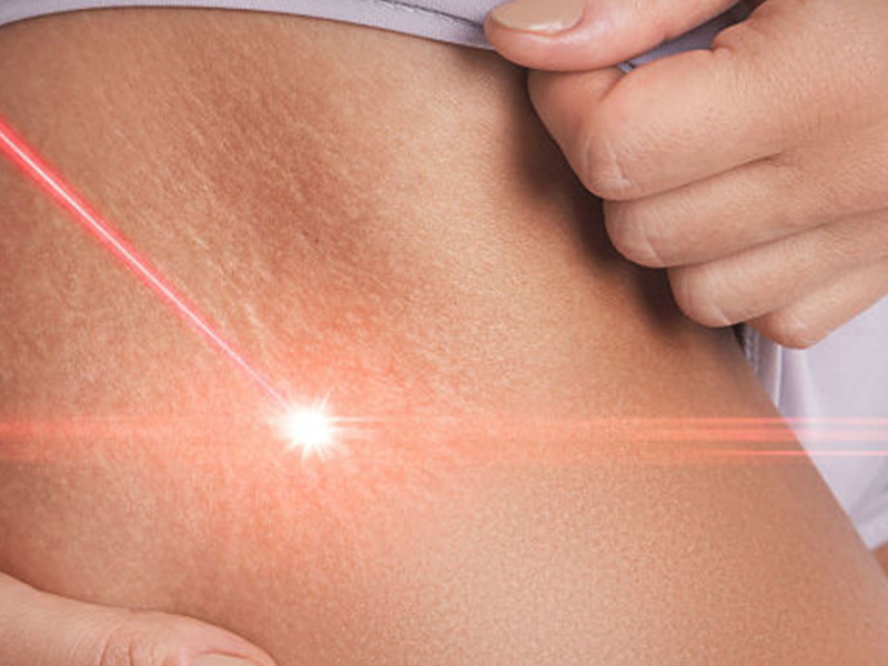 Can Laser Remove Stretch Marks? Everything You Need To Know