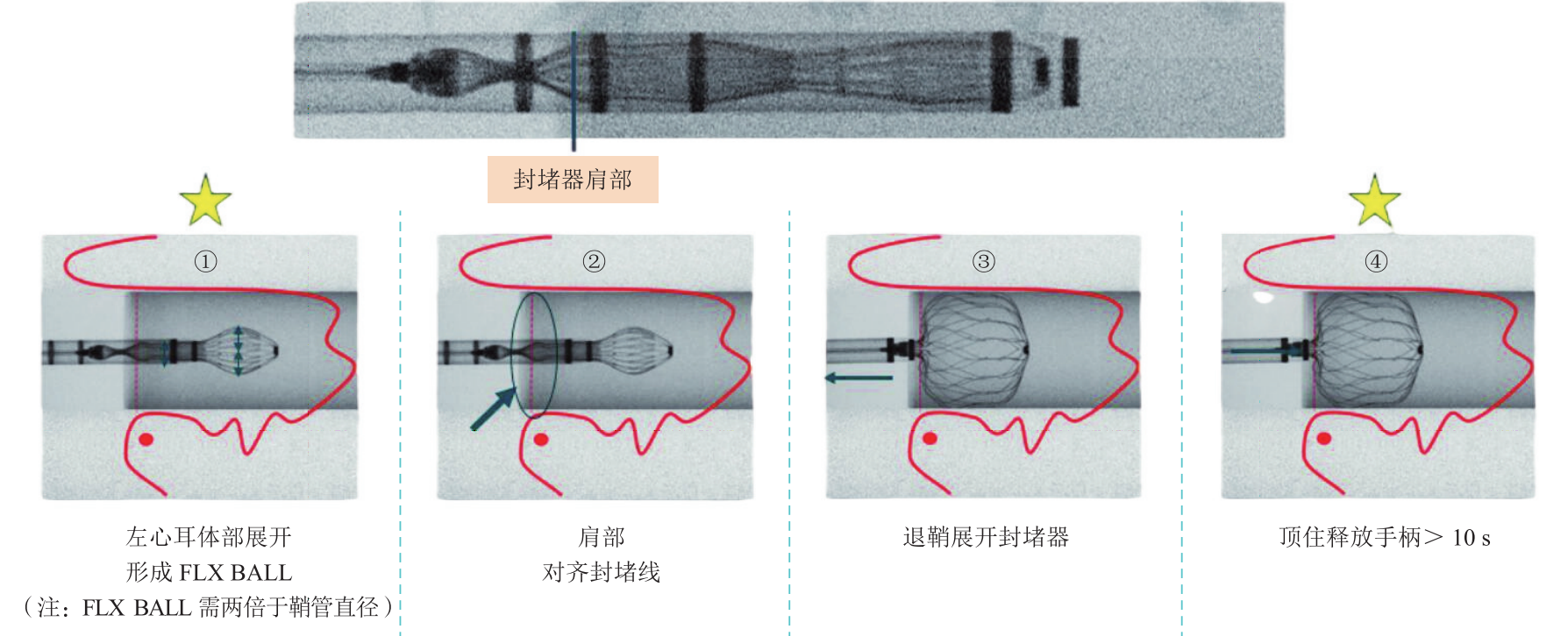 《中国经导管左心耳封堵术临床路径专家共识（2025版）》全面解读