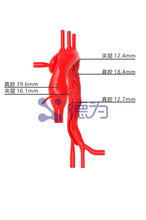 主动脉弓夹层模型 主动脉弓夹层模型