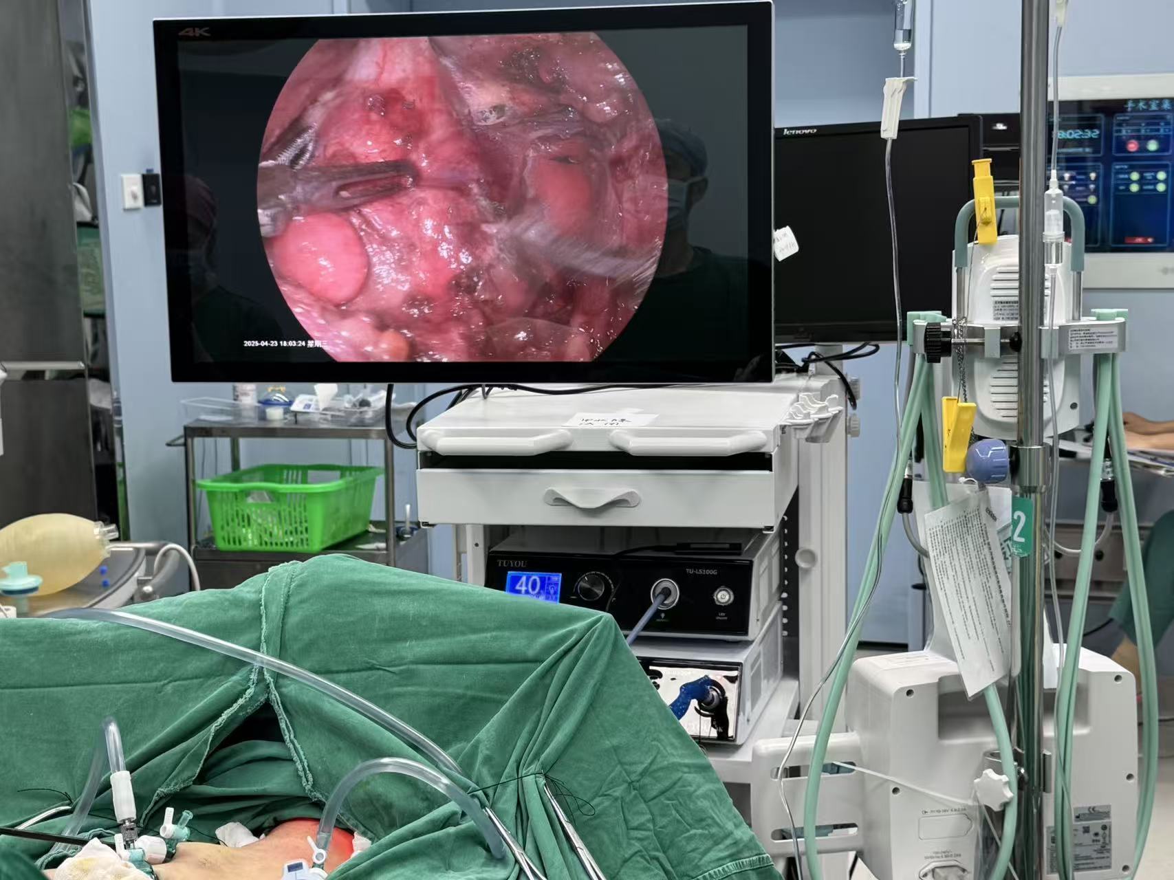 Laparoscopy